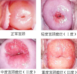 宮頸糜爛