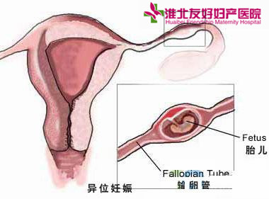 怎么知道是患上了宮外孕