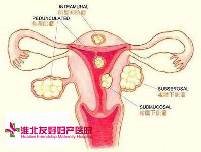 子宮肌瘤多大算嚴重