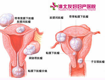 子宮肌瘤的產生原因